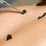 Try Raktamokshana Treatment To Heal Skin And Reduce Inflammation Try Raktamokshana Treatment To Heal Skin And Reduce Inflammation