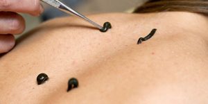 Try Raktamokshana Treatment To Heal Skin And Reduce Inflammation