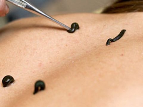 Try Raktamokshana Treatment To Heal Skin And Reduce Inflammation